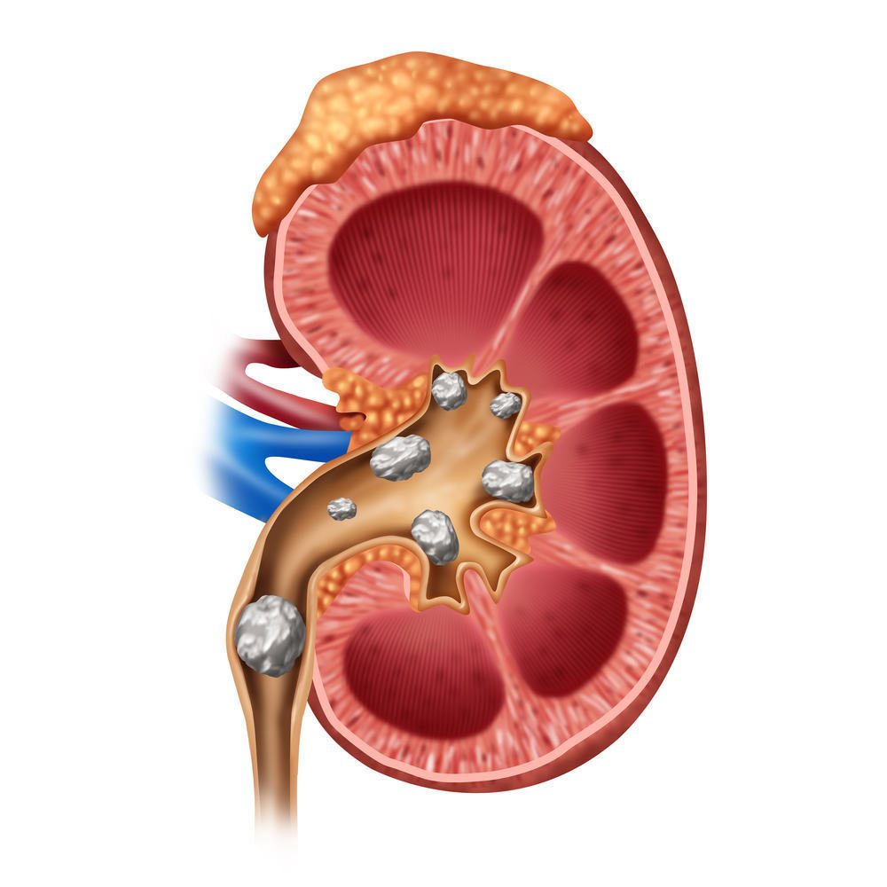 Kidney Stones Risk Factors
