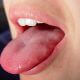 5 Early Symptoms Of Tongue Cancer