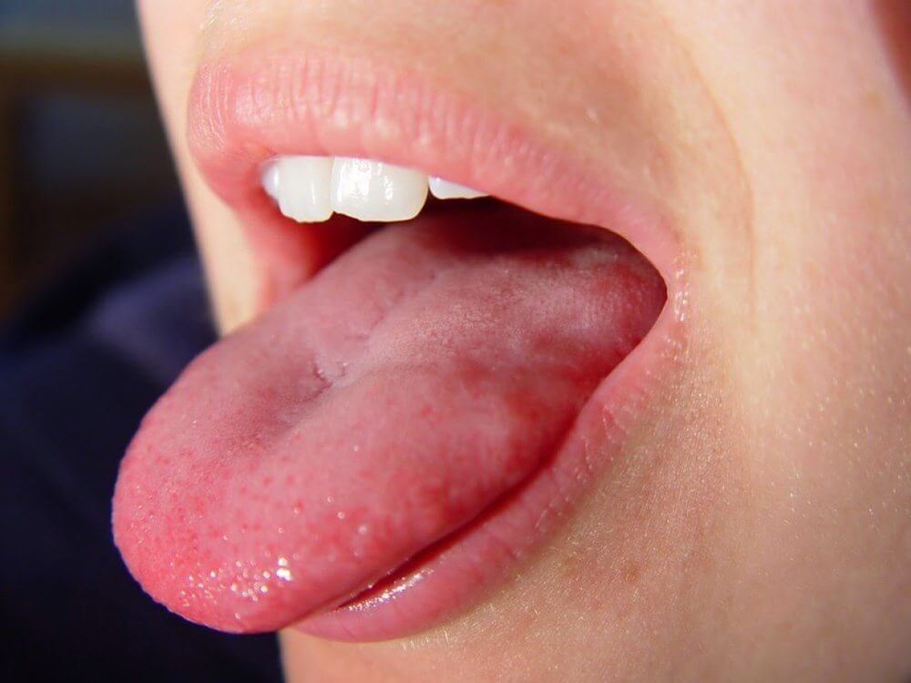 5 Early Symptoms Of Tongue Cancer
