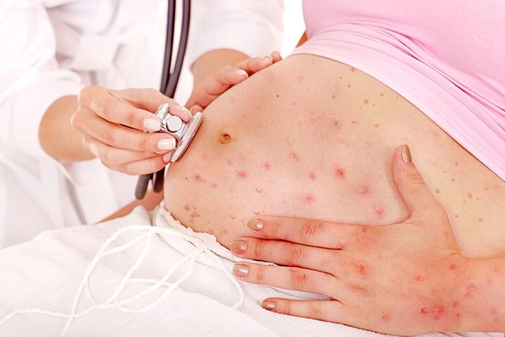 Know Everything About Chickenpox In Babies - ebuddynews