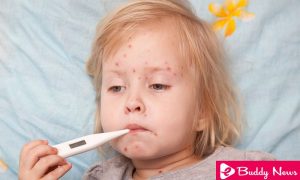 Know Everything About Chickenpox In Babies - ebuddynews