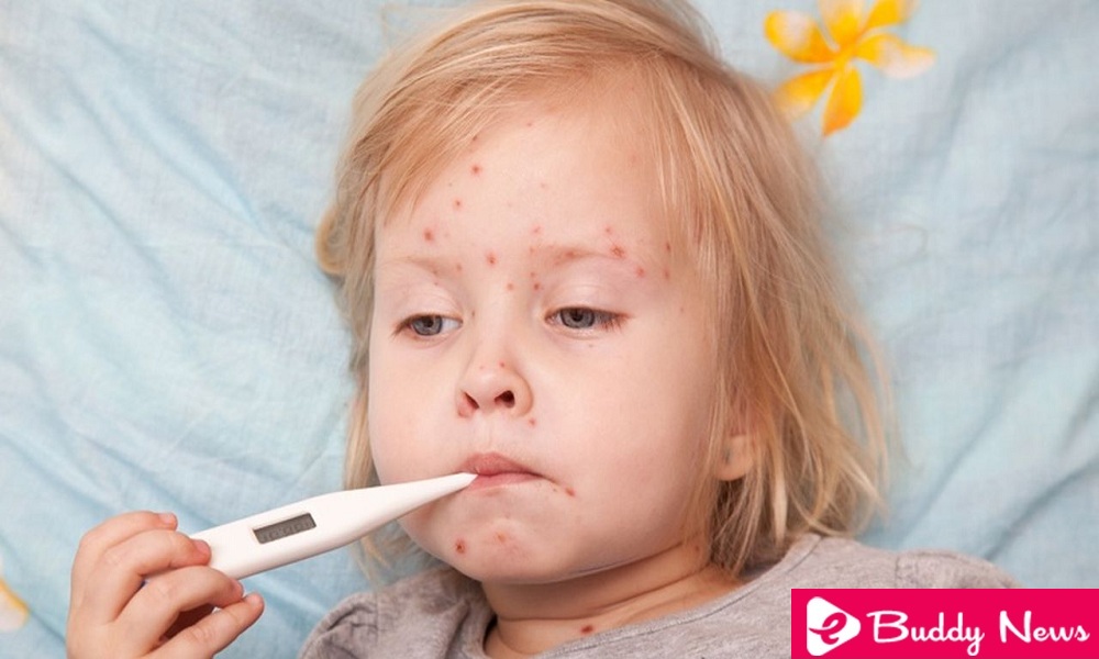 Know Everything About Chickenpox In Babies - ebuddynews