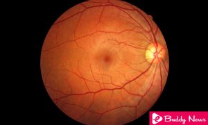 Foods To Prevent Macular Degeneration - ebuddynews