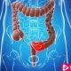 Researchers Find A Key Piece to Stop Colon and Rectal Cancer - ebuddynews
