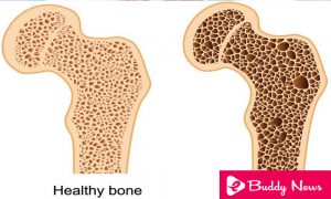 Bone Health Osteoperosis - eBuddy News
