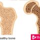 Bone Health Osteoperosis - eBuddy News