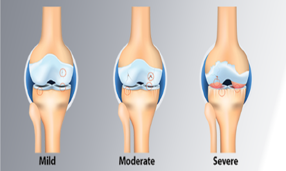 Stages Of Knee Osteoarthritis - eBuddy News