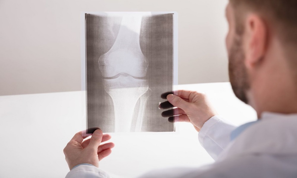 Why Is It Important To Receive A Timely Diagnosis of Osteoarthritis - eBuddy News