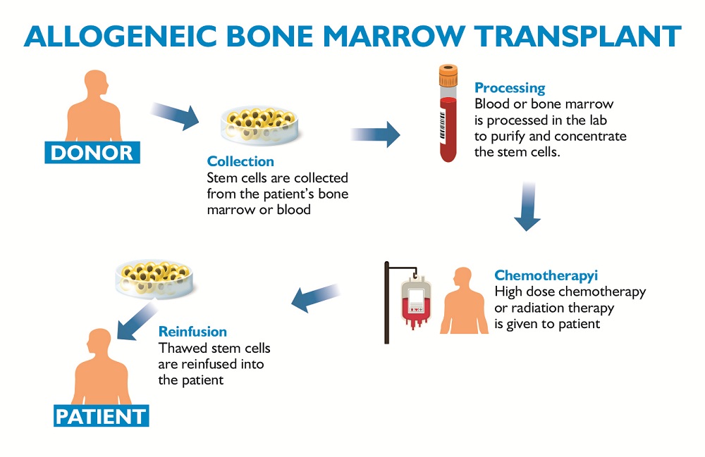 Bone Marrow Donation Process - eBuddy News