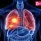 Lung Cancer Symptoms, Diagnosis, And Its Treatment - ebuddynews