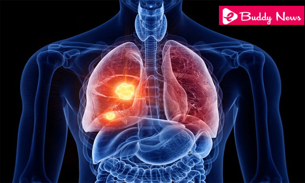 Lung Cancer Symptoms, Diagnosis, And Its Treatment - ebuddynews