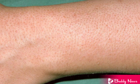 What Is Keratosis Pilaris Symptoms And Its Causes And Treatment - ebuddynews