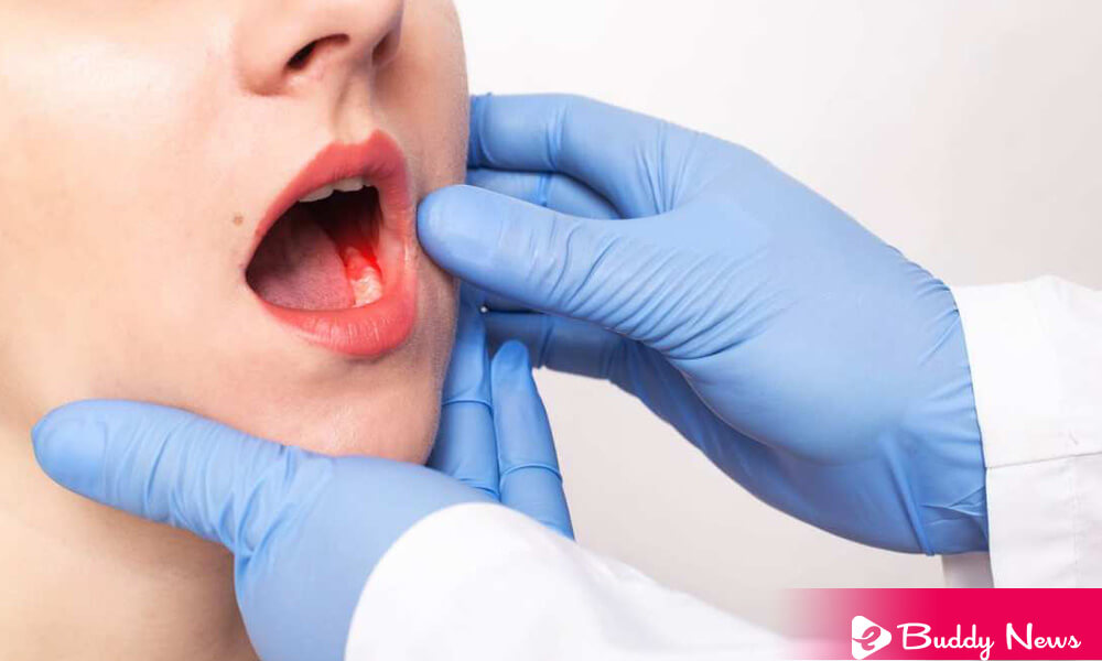 What Is The Oral Cancer Its Symptoms, Stages, And Treatment - ebuddynews