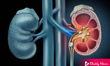 You Should Know How Kidney Stones Form And Its Types, Treatment - ebudyynews