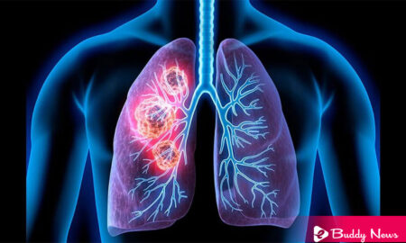Researchers Developed A Model To Identify Patients With Poor Outcomes In Lung Cancer - ebuddynews