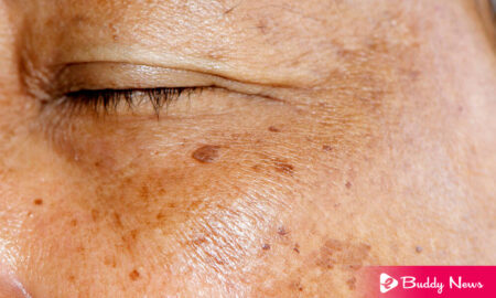 Skin Spots, Its Types, Symptoms, Causes, And Treatment - ebuddynews